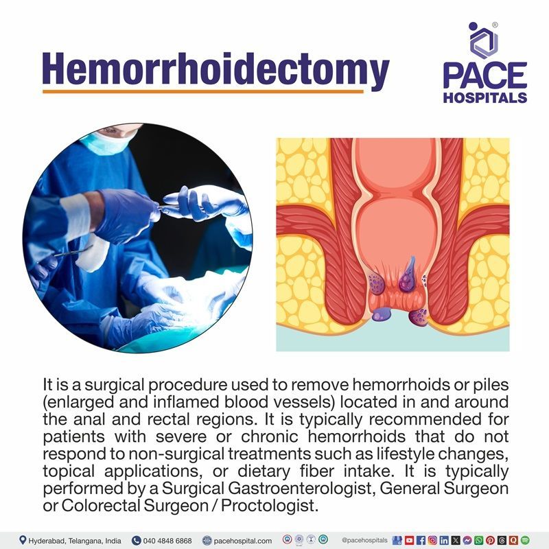 Hemorrhoidectomy Meaning Hemorrhoidectomy definition | hemorrhoidectomy Meaning | What is hemorrhoidectomy