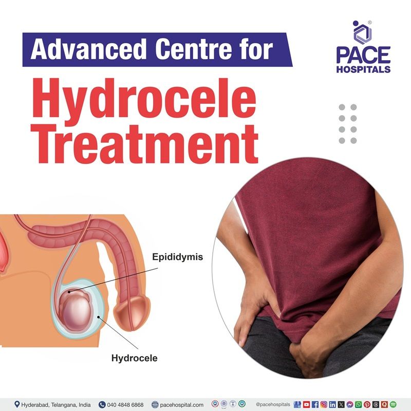 Best Hydrocele Treatment Hospital in Hyderabad, Telangana Best Treatment for Hydrocele in Hyderabad, India | Hydrocele Treatment in Hyderabad | hydrocele hospital near me
