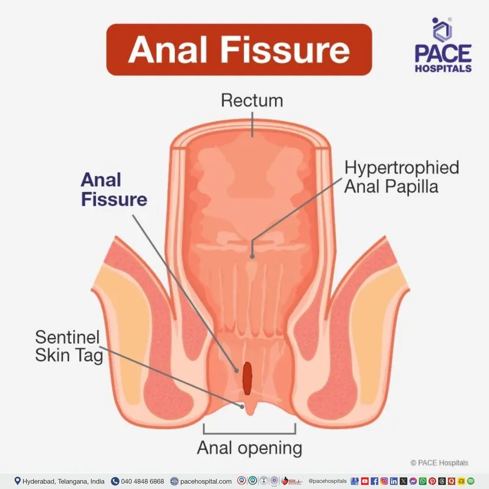 anal fissure picture | fissure in ano images | chronic anal fissure skin tag | anorectal fissure | anal fissure real images