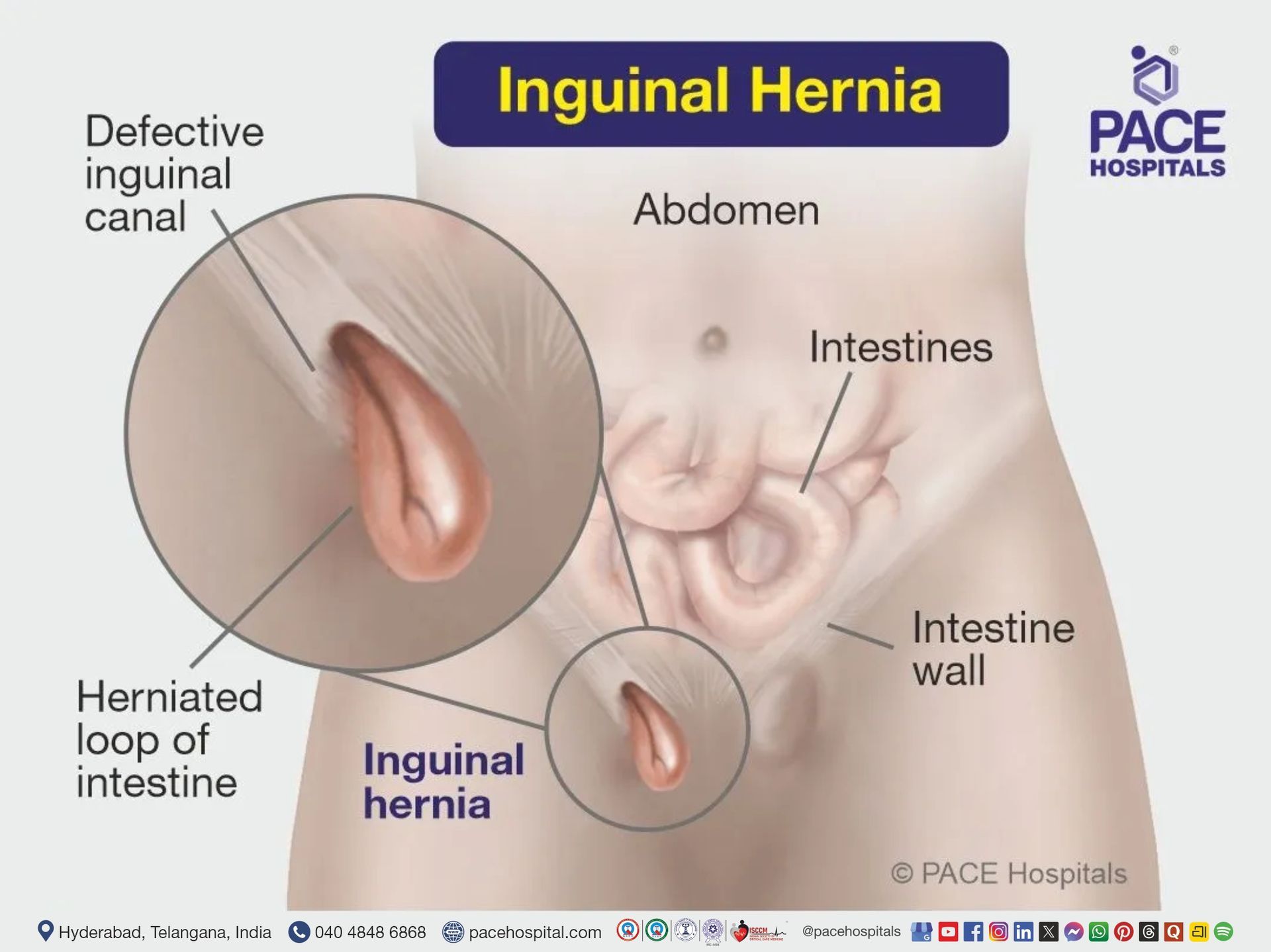 inguinal hernia real pictures | inguinal hernia anatomy | hernia inguinal meaning | direct and indirect inguinal hernia treatment in hyderabad india
