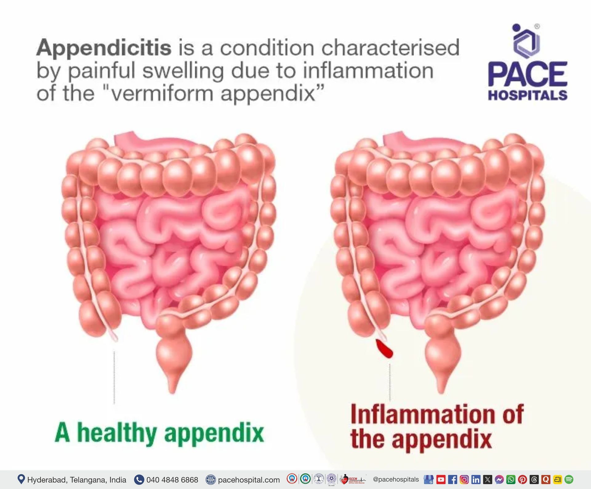 appendix meaning | appendicitis pain location | appendicitis meaning | appendicitis pain area