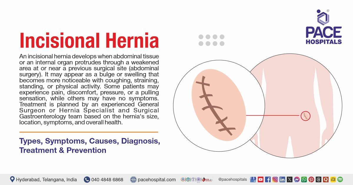 Incisional Hernia – Symptoms, Causes, Diagnosis and Treatment