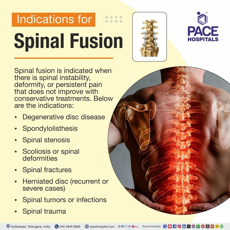 Indications of Spinal Fusion Surgery Signs for Spinal fusion surgery | Visual depicting the indications of Spinal fusion surgery