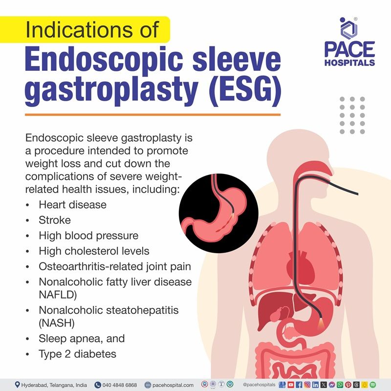 Indications for Endoscopic Sleeve Gastroplasty (ESG) endoscopic sleeve gastroplasty indications | endoscopic sleeve gastroplasty results | endoscopic sleeve gastroplasty India