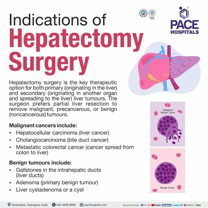indications of hepatectomy surgery laparoscopic hepatectomy surgery in hyderabad, Telangana | hepatectomy indications | hepatectomy procedure