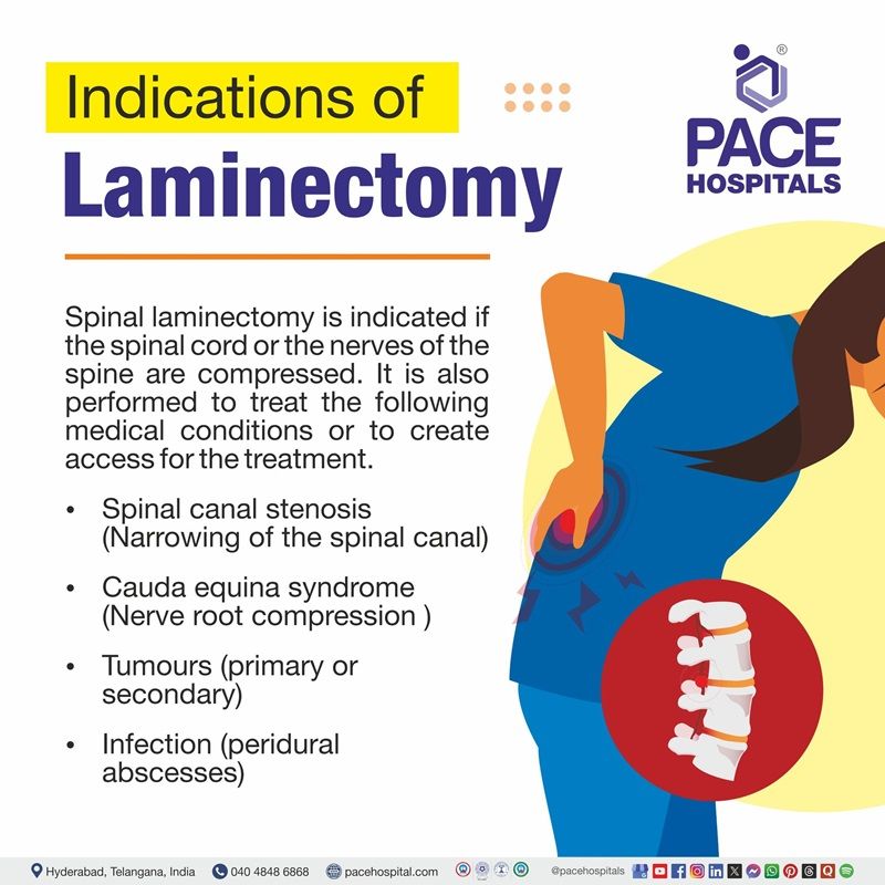 Indications of laminectomy Laminectomy indications | image showing the list various Indications of laminectomy