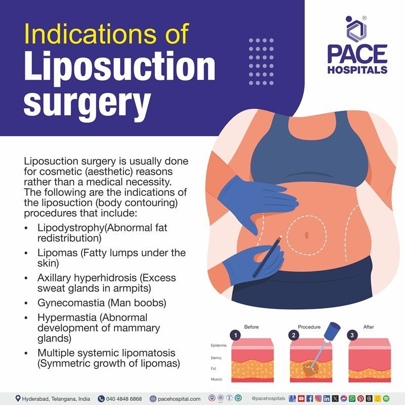 Liposuction surgery indications Indications of liposuction surgery | liposuction operation in Hyderabad | liposuction procedure in India | liposuction images | liposuction fat removal in Hyderabad