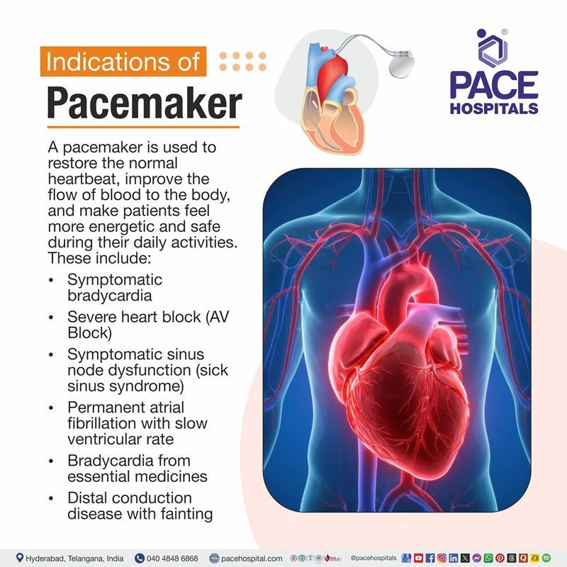 Indications of Pacemaker image narrating the indications of pacemaker | signs when pacemaker is recomemded or required