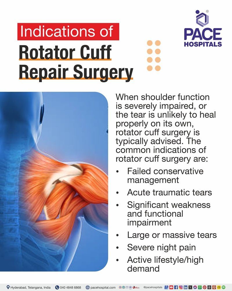 Indications for Rotator Cuff Repair Surgery Medical depiction of rotator cuff tears and shoulder conditions that may require surgical intervention.