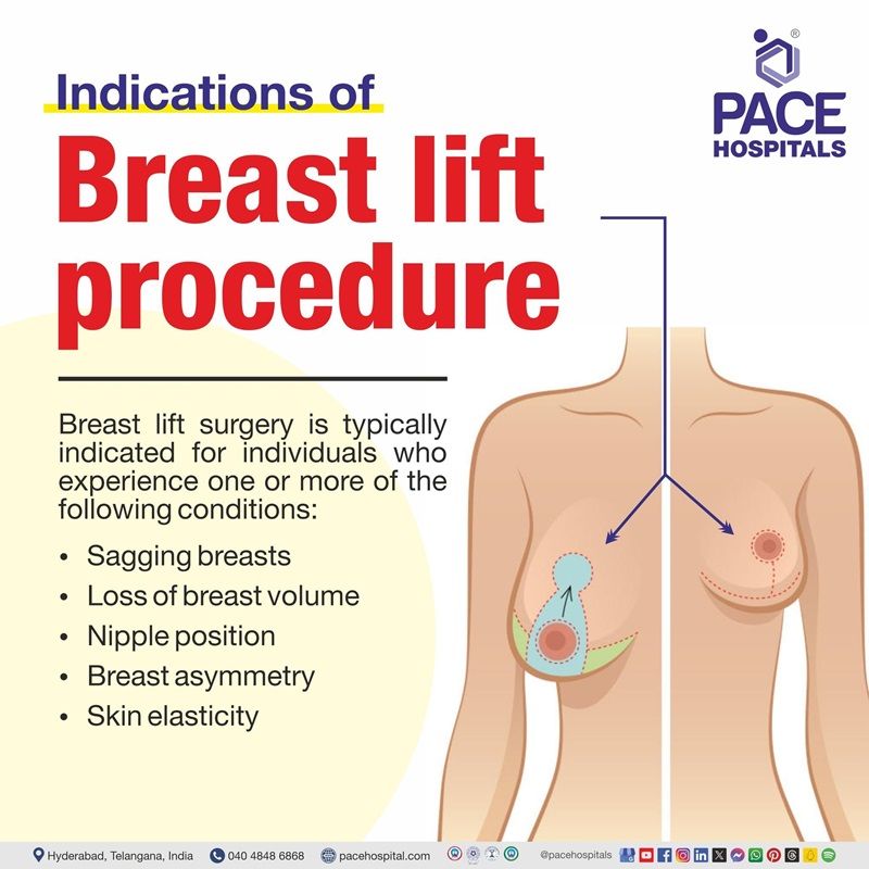 Breast lift surgery indications breast lift surgery indications | What are the indications of breast lift surgery | visual depicting the indications of breast lift treatment