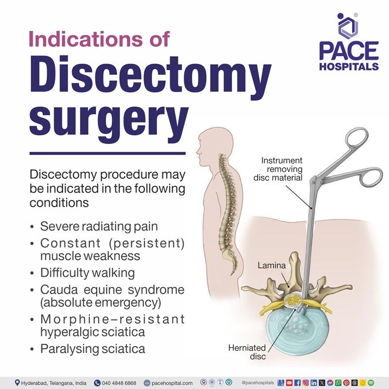 Discectomy indications Indications of Discectomy surgery or procedure