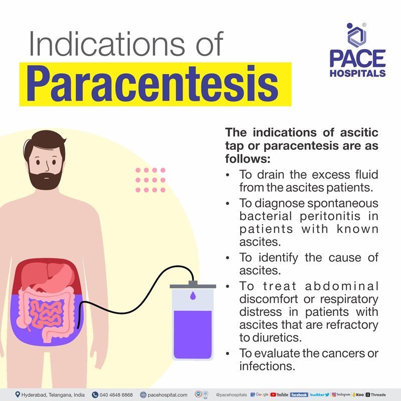 ascites tapping - paracentesis indications paracentesis indications | ascitic tapping indication | ascites tapping procedure indication