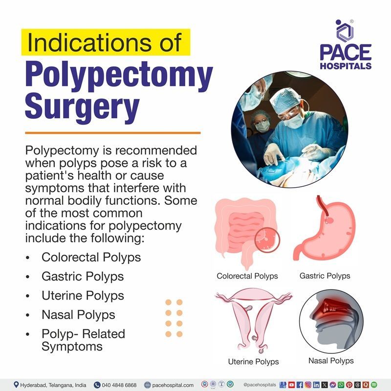 Polypectomy Procedure Indications When is a polypectomy indicated | Polyps Removal Surgery Indications | Endoscopic Polypectomy Indications