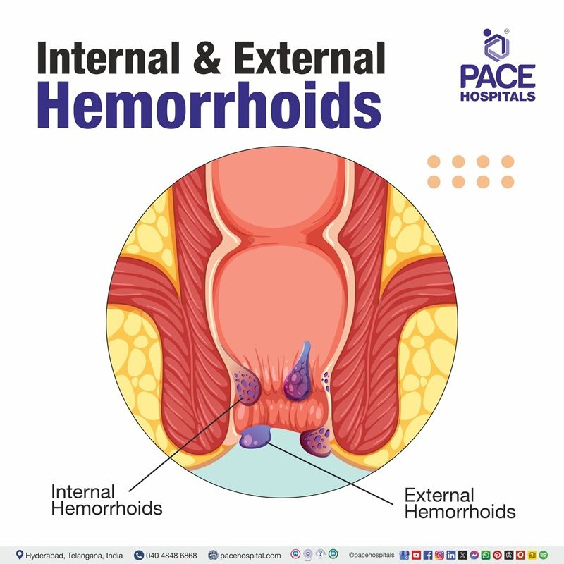 Internal and External Hemorrhoids External hemorrhoids photo | hemorrhoids pictures | Image showing internal and external hemorrhoids