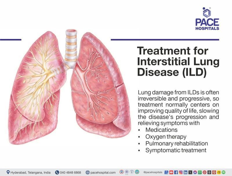 Interstitial lung disease treatment interstitial lung disease treatment | interstitial lung disease alternative treatment | ILD disease treatment in India | ILD disease treatment | treatment of ILD | Visual depicting the treatment of Interstitial lung disease
