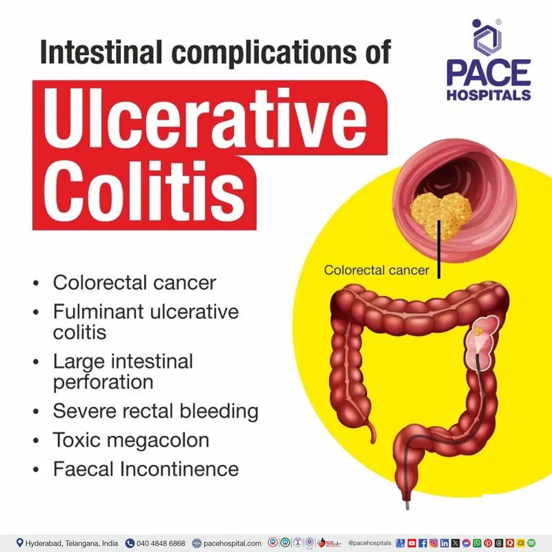 intestinal ulcerative colitis intestinal ulcerative colitis | intestinal manifestations of ulcerative colitis
