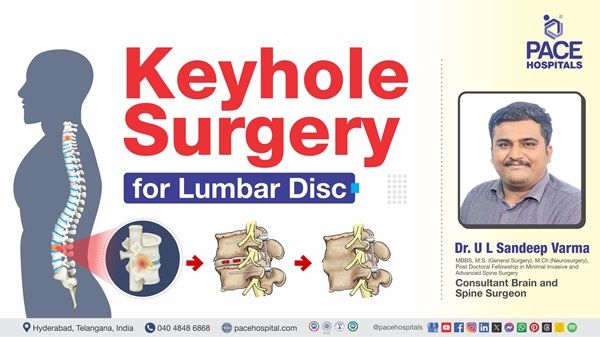 Dr. U L Sandeep Varma from PACE Hospitals explaining keyhole surgery for lumbar disc in this video.