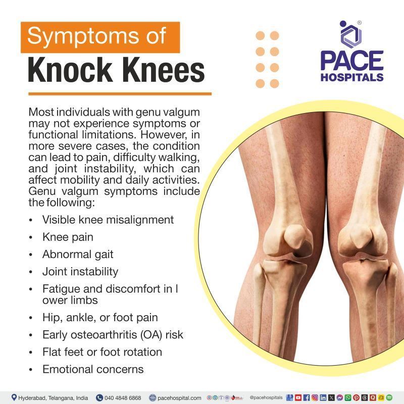 Knock Knees (Genu Valgum) Symptoms Knock Knees Symptoms | Genu valgum symptoms | Symptoms of Knock Knees