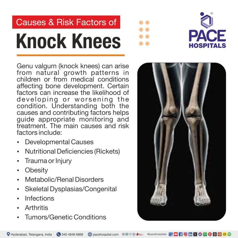 Knock Knees (Genu Valgum) Causes Knock knees causes | Genu valgum causes | What causes knock knees | What causes genu valgum
