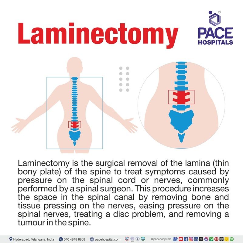 What is Laminectomy Surgery laminectomy meaning | laminectomy definition | Best hospital for Laminectomy Procedure in Hyderabad, Telangana, India