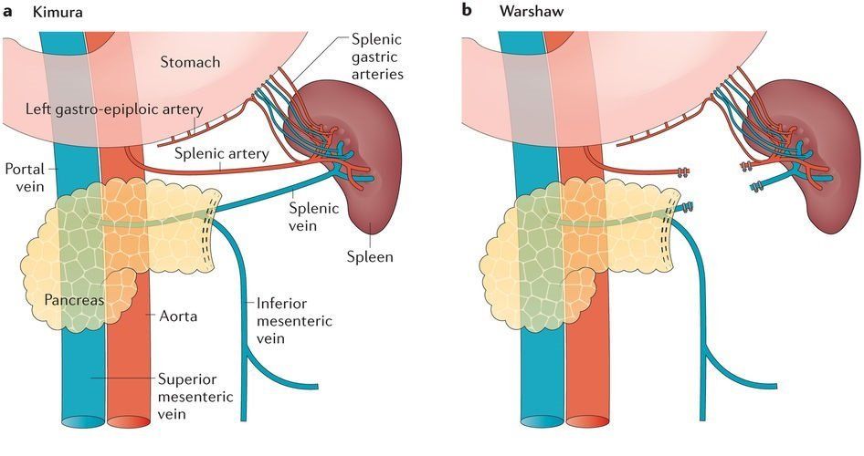 Distal Pancreatectomy Kimura and Warshaw techniques Laparoscopic Distal Pancreatectomy Kimura and Warshaw techniques