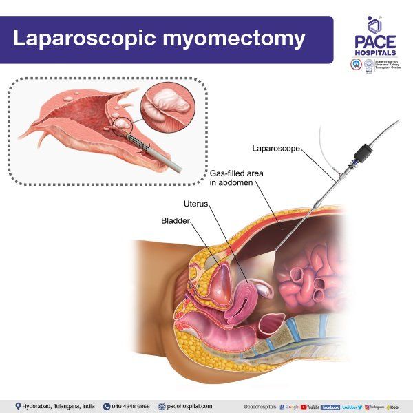 Laparoscopic Myomectomy for Uterine Fibroids Treatment Laparoscopic Myomectomy in Hyderabad | Laparoscopic Myomectomy | Laparoscopic fibroid removal
