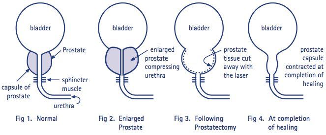 Laser Prostatectomy Laser Prostatectomy - Purpose, Types, Procedure, Risks & Recovery