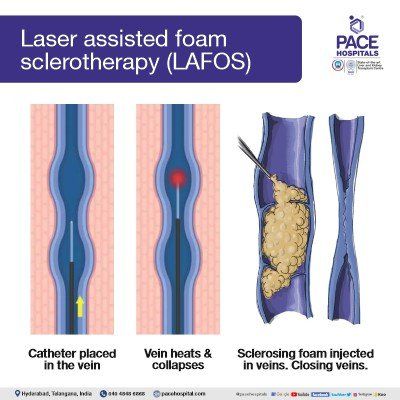 Laser assisted foam sclerotherapy (LAFOS) Laser assisted foam sclerotherapy (LAFOS) varicose veins treatment in hyderabad | varicose vein surgery