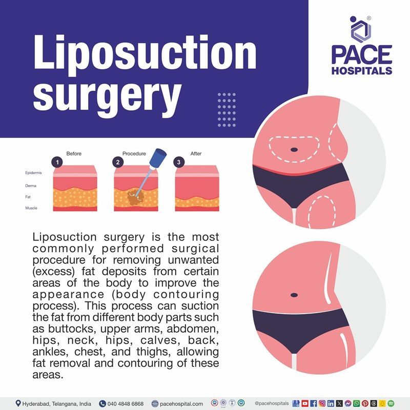What is Liposuction Surgery best liposuction hospital in Hyderabad | liposuction meaning | liposuction cost in Hyderabad | best liposuction in Hyderabad | liposuction near me