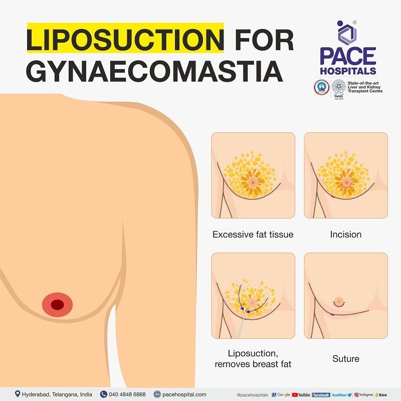 Liposuction for gynecomastia Liposuction in Hyderabad | Liposuction for gynecomastia in India