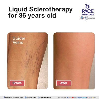 Liquid Sclerotherapy for spider veins treatment in hyderabad | varicose vein surgery