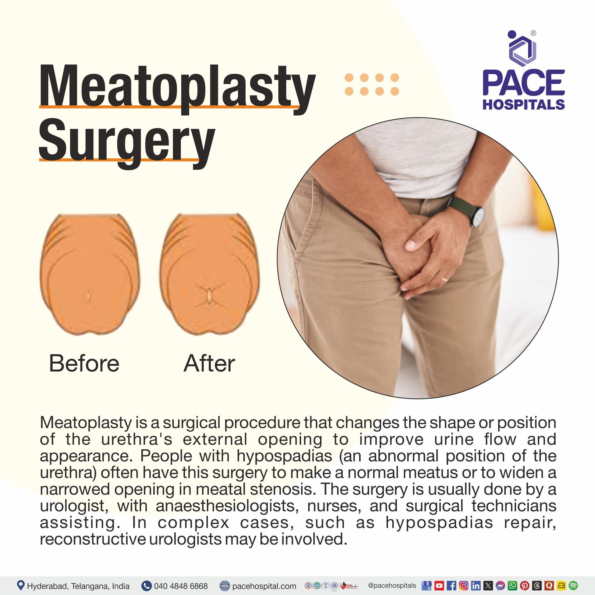 Meatoplasty Meaning Meatoplasty meaning | Meatoplasty Procedure | what is meatolplasty surgery