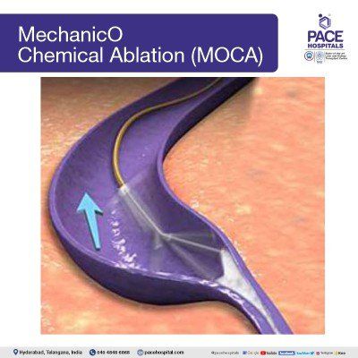 mechanico chemical ablation (MOCA) mechanico chemical ablation (MOCA) for varicose veins treatment in hyderabad in hyderabad | varicose vein surgery