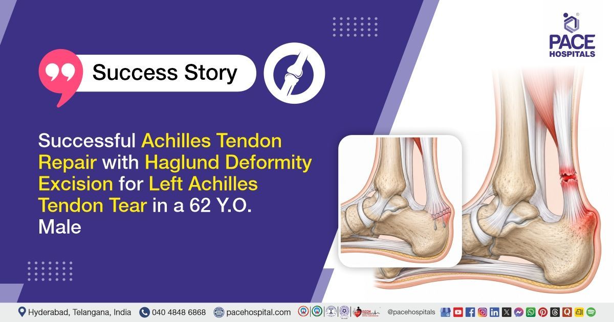 Successful Haglund Deformity Excision and Achilles Tendon Trear Repair in a 62 Y.O at PACE Hospitals