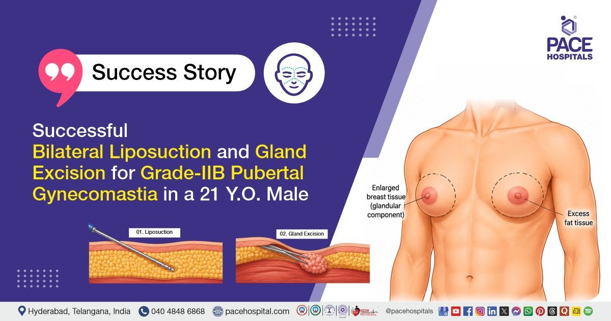 Successful Liposuction and Gland Excision for Grade 2B Pubertal Gynecomastia at PACE Hospitals