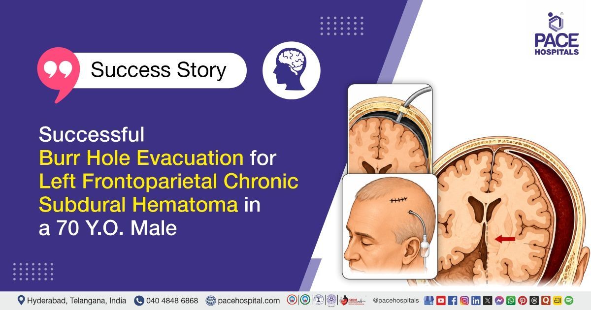 Successful burr hole evacuation for chronic subdural hematoma treatment at PACE Hospitals