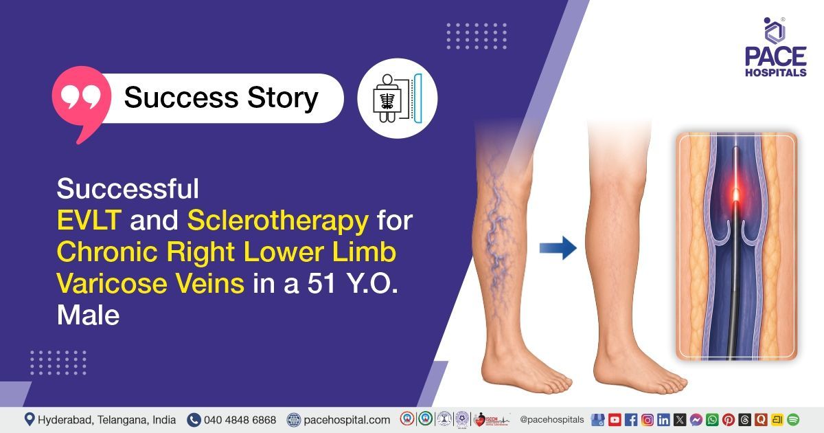 Successful EVLT and sclerotherapy for chronic varicose veins treatment at PACE Hospitals