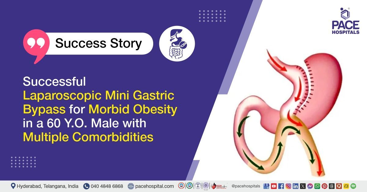 Case study of a 60-YO male patient who underwent laparoscopic mini-gastric bypass at PACE Hospitals