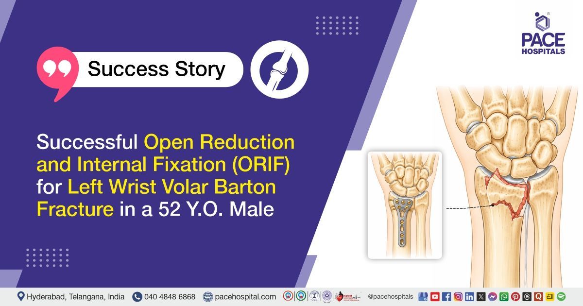 Successful ORIF surgery for left wrist volar Barton fracture treatment in 52 Y.O. at PACE Hospitals