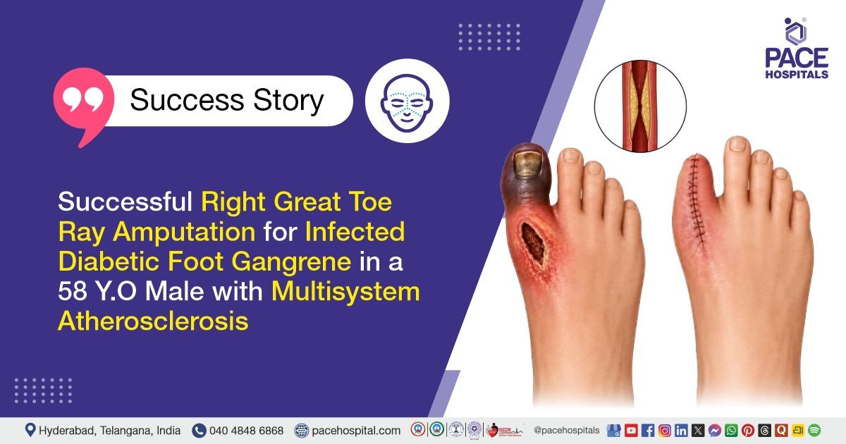 Successful Right great toe ray amputation for diabetic foot gangrene treatment at PACE Hospitals