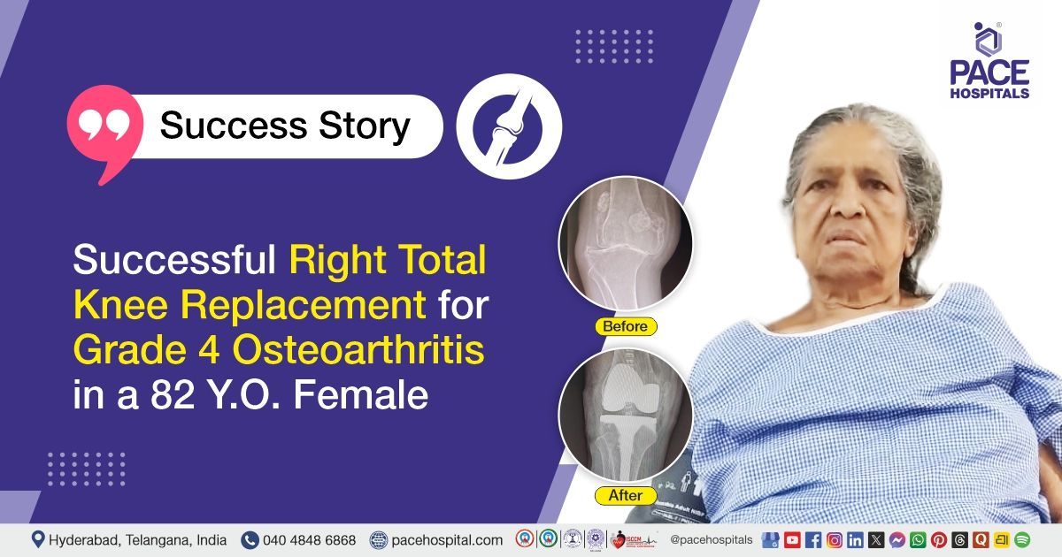 Successful Total Knee replacement surgery for severe grade 4 knee osteoarthritis at PACE Hospitals