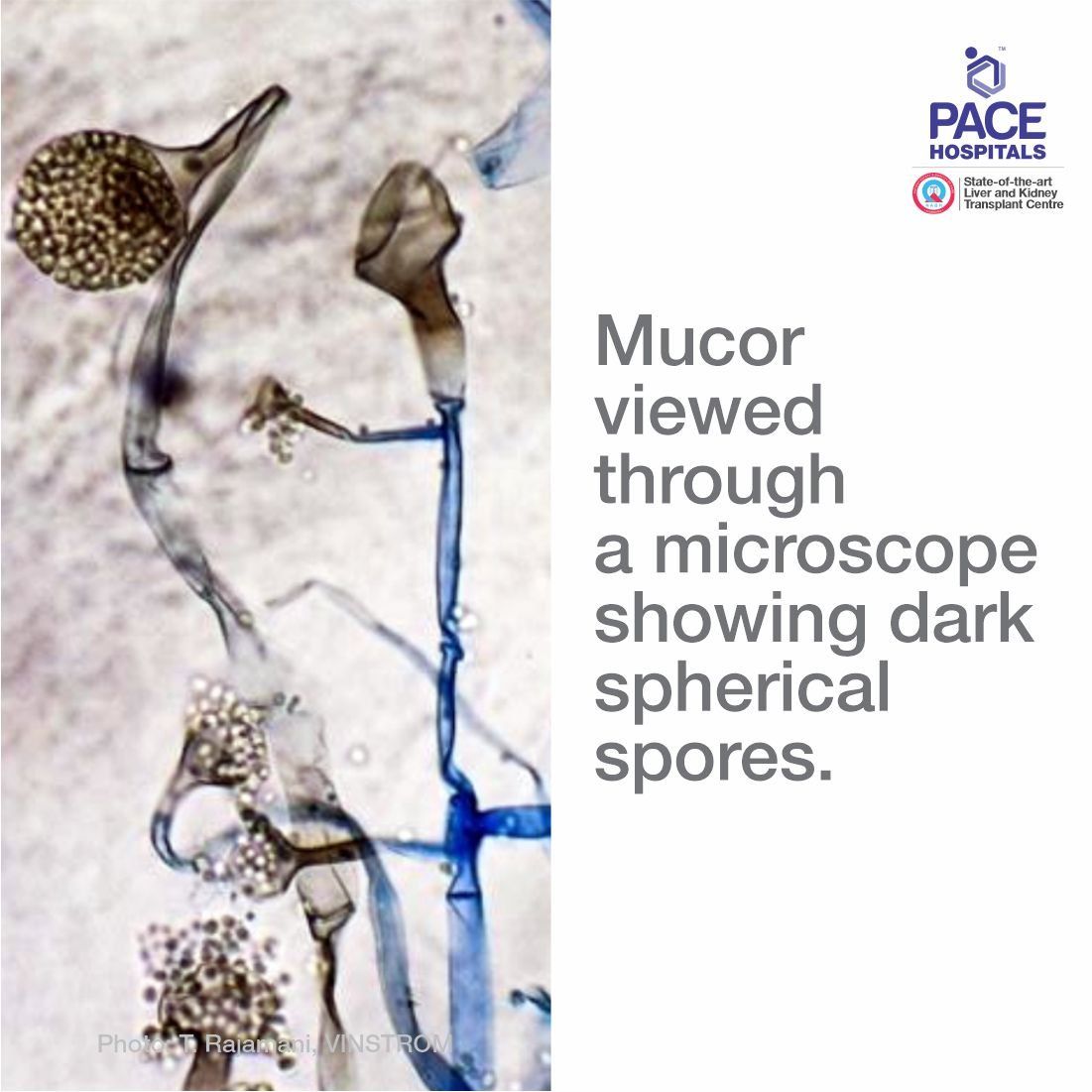 Mucor fungi viewed through a microscope showing dark spherical spores