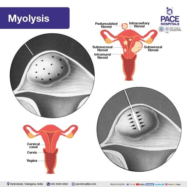Myolysis for Uterine Fibroids Treatment Myolysis in Hyderabad | Myolysis for Fibroids | Myolysis Fibroids Treatment