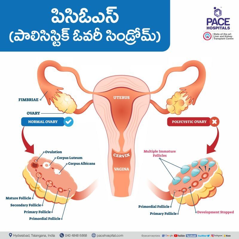 PCOS అంటే ఏమిటి PCOS అంటే ఏమిటి