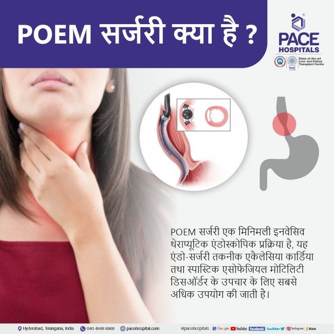 POEM for achalasia cardia POEM for achalasia cardia in Hindi | POEM surgery in Hindi