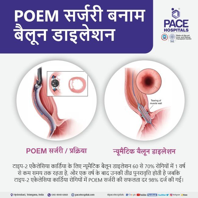POEM vs balloon dilatation for type 2 achalasia in Hindi