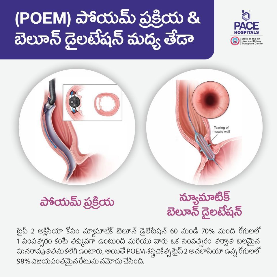 POEM vs balloon dilatation for type 2 achalasia in telugu