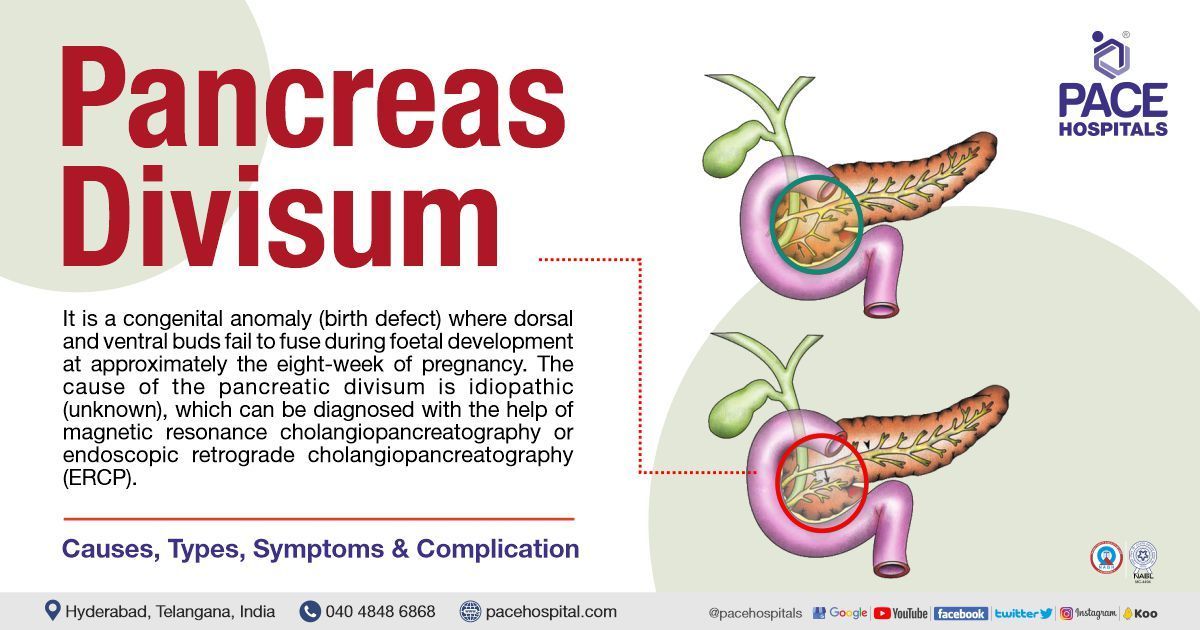 Pancreas Divisum - Symptoms, Causes, Types, Complications, Treatment