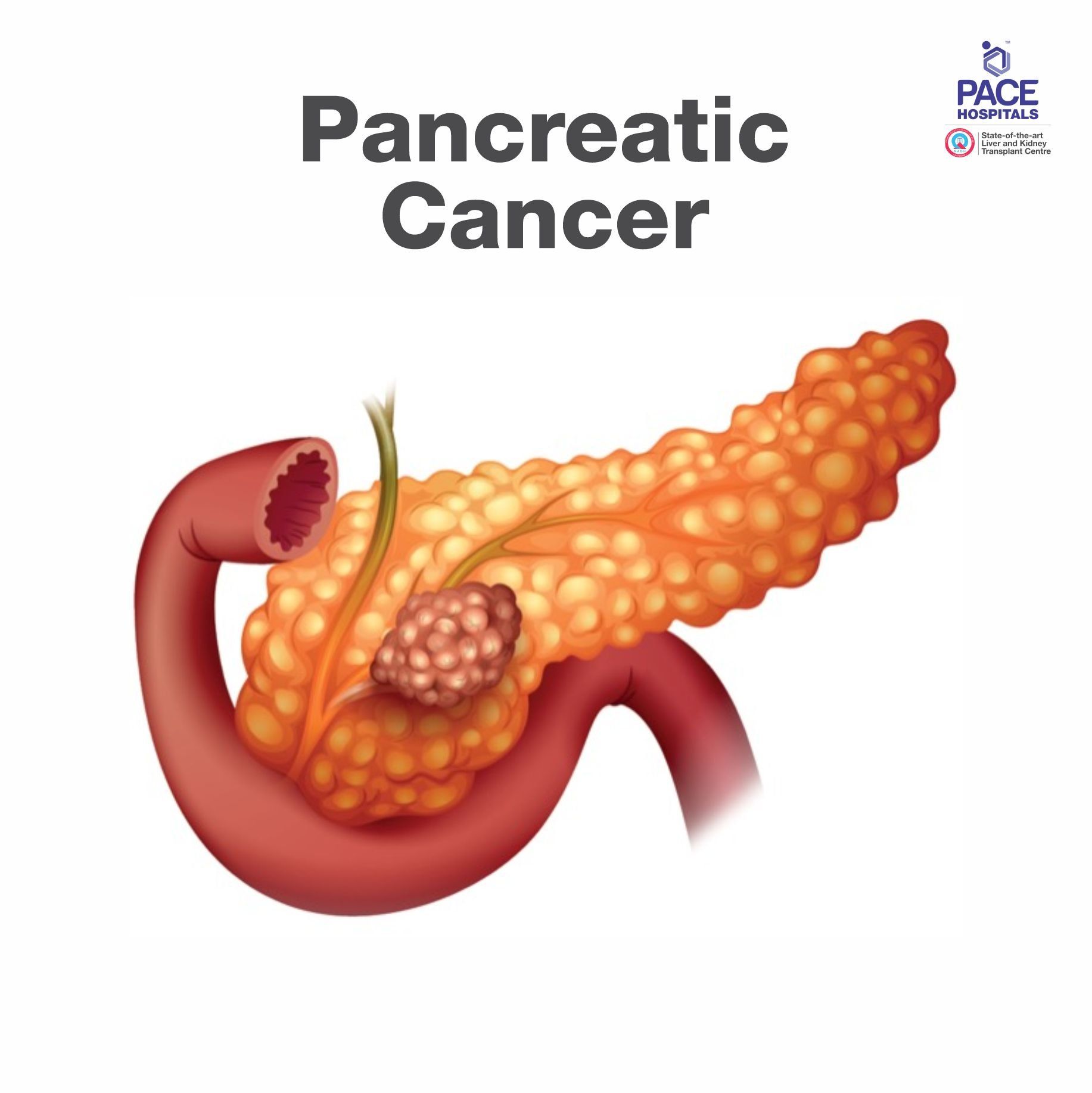 image depicting cancer affter pancreas