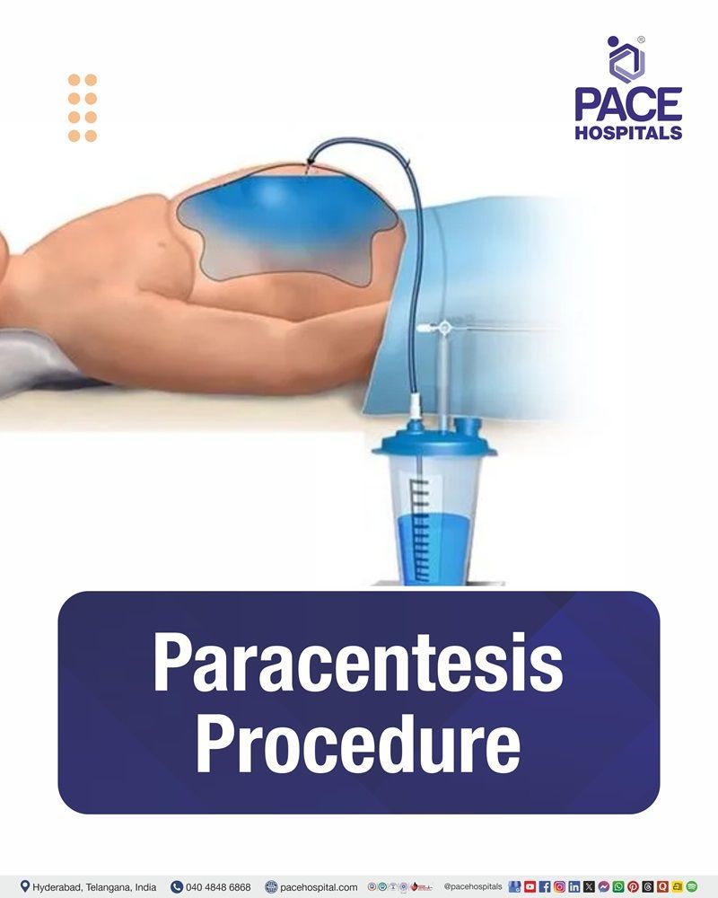 Paracentesis Procedure Cost in Hyderabad | Affordable Ascitic Tap Procedure in India